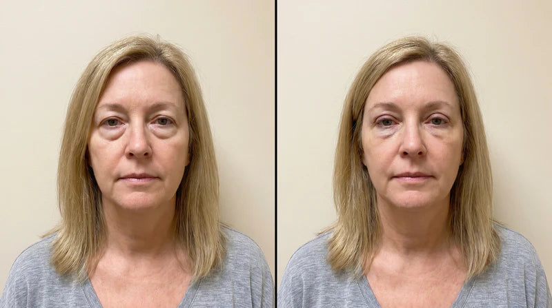 Linda M. before and after, 6 weeks