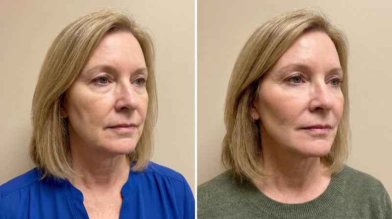 Patricia D. before and after, 12 weeks