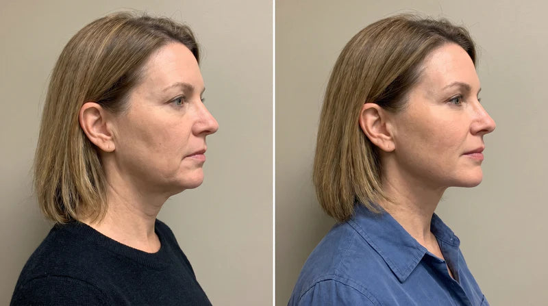 Ana V. before and after, 10 weeks